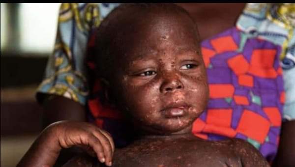 Cameroun : revoici la campagne de vaccination contre la rougeole et la rubéole